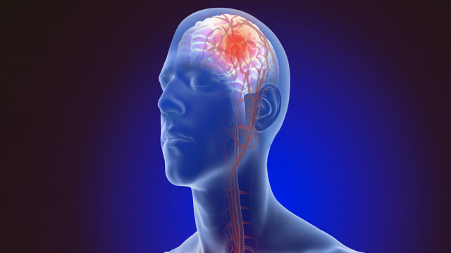 Waspadai Gejala Silent Stroke pada Usia Muda dan Faktor Risiko Penyebabnya yang Jarang Disadari